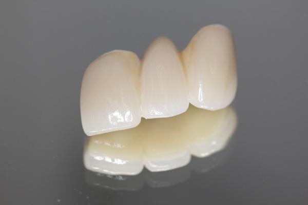 What To Expect Before, During, And After Dental Bridge Placement
