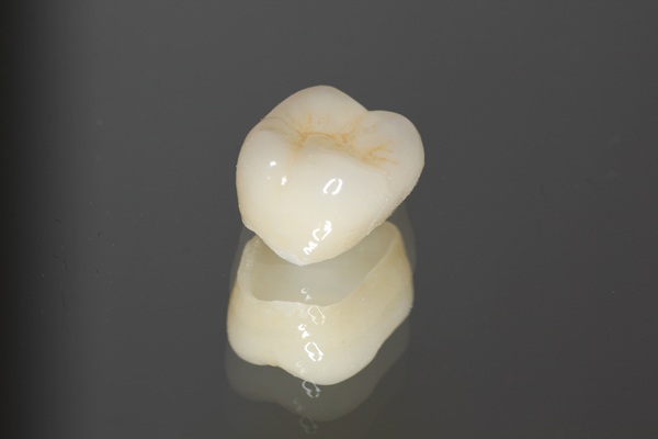 Dental Restoration    : Should I Get A Dental Crown Or Filling?
